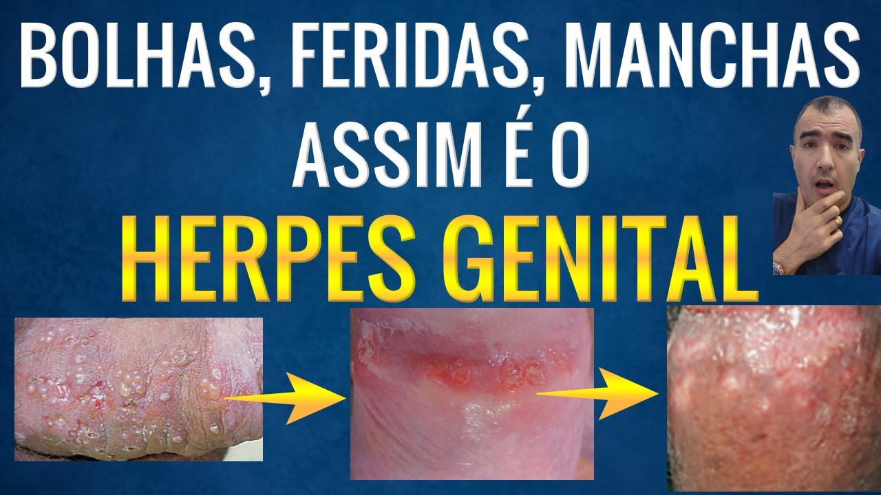 Herpes no Pênis