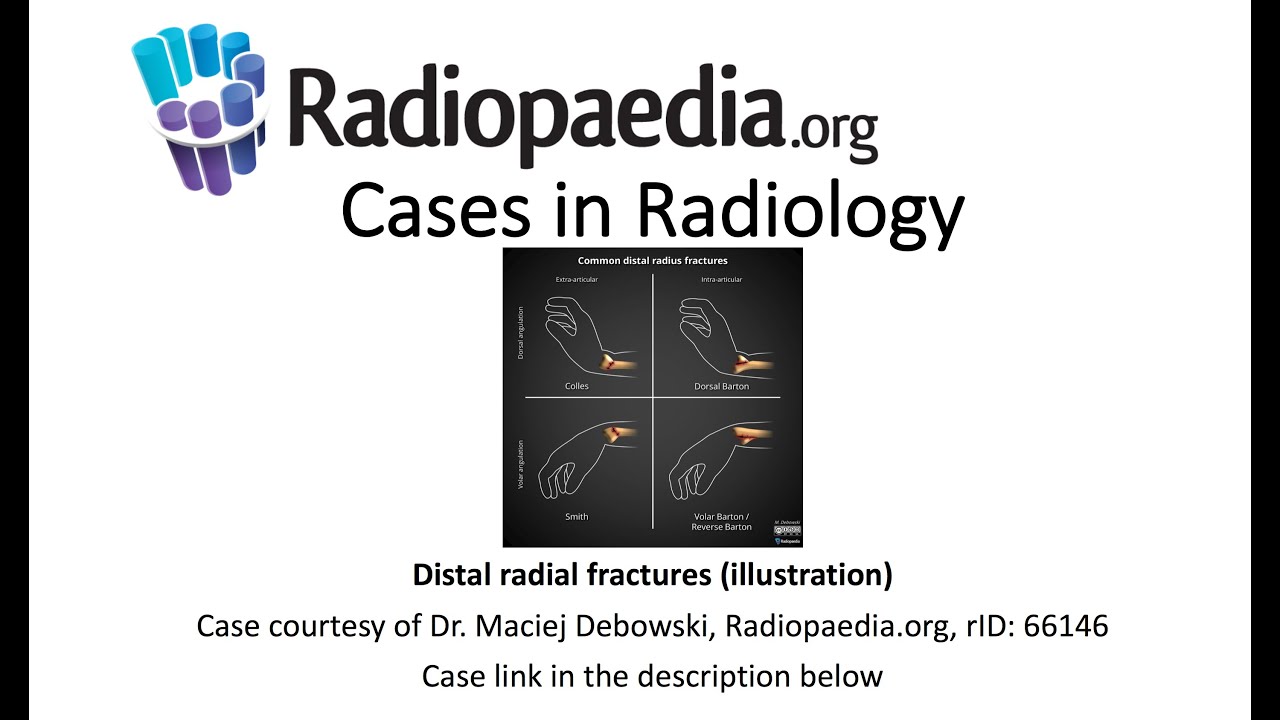 Distal radial fractures (Radiopaedia.org) Cases in Radiology
