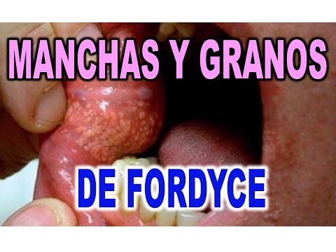 La operación plástica el miembro viril