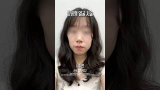 쥬베룩볼륨으로 얼굴 라인 극복