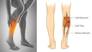 How to Stop Leg Muscle Cramps