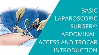 Basic Laparoscopic Surgery: Abdominal Access and Trocar Introduction