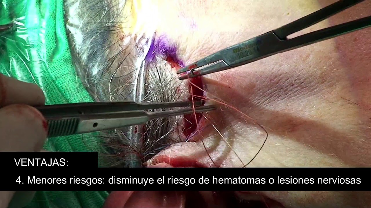 VENTAJAS DE UN MINILIFTING FRENTE AL LIFTING COMPLETO (English subtitles)