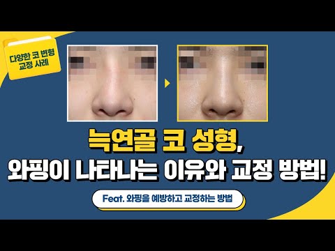 [ 코 변형 쿄정 사례] 늑연골로 코 성형 시, 와핑이 일어날 수밖에 없다고? (Feat. "교정 방법도 있나요?")