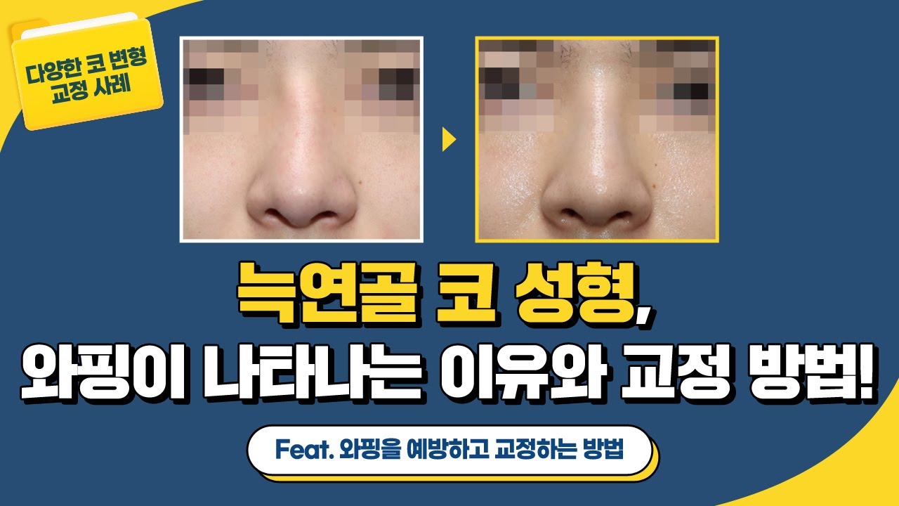 [ 코 변형 쿄정 사례] 늑연골로 코 성형 시, 와핑이 일어날 수밖에 없다고? (Feat. "교정 방법도 있나요?") 썸네일