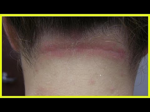 Wie das Birkenpech bei der Schuppenflechte zu schmieren Die medikamentösen Mittel der Schuppenflechte