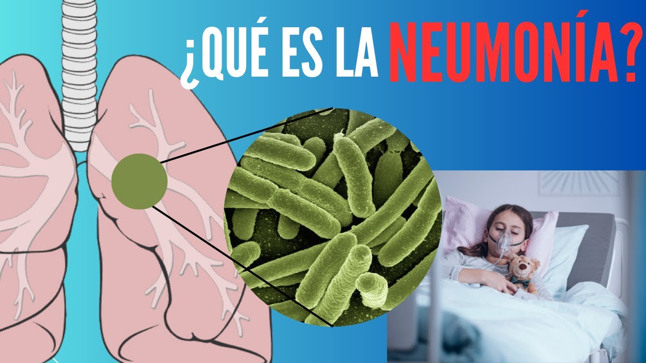 ¿Qué es la Neumonía