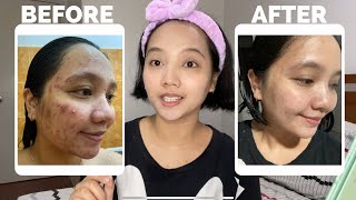 HOW I GOT RID OF MY ACNE | Pregnancy Acne Journey + Giveaway!