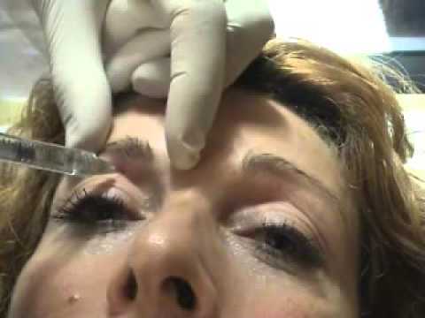 Togliere cerchi sotto occhi una mesotherapy I meela meelo affrontano il pacco