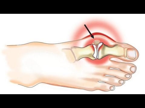 Funkcionális fájdalom a csípőízületben