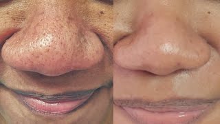 How to TREAT OILY SKIN and GET RID of  LARGE PORES ON NOSE & FACE - AWESOME Pore Cleaning Tool Demo