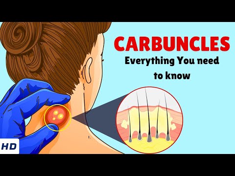 Carbuncles – Causes, Signs and Symptoms, Diagnosis & Treatment
