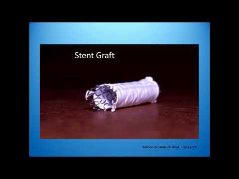 My Worst Iliac Complication - Mark Burket, MD