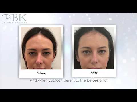 Rosies non-surgical rhinoplasty story