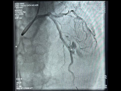 Coronary artery perforation Covered stent by ping pong technique PCI complication nightmare