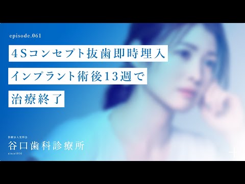 第61話 ４Sコンセプト抜歯即時埋入インプラント術後13週で治療終了❗️-札幌駅前-赤れんがテラス-谷口歯科診療所
