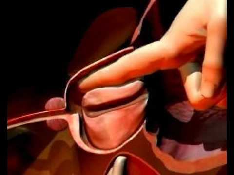 Espe bei der Behandlung von Prostata-Adenom Speman Prostata Bewertungen
