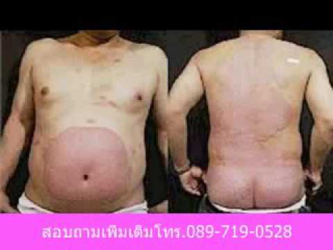 Protopic 0.1 โรคสะเก็ดเงิน รักแร้รักษากลาก
