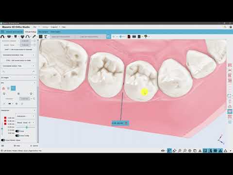 Virtual Setup | IPR, Stripping and Extractions