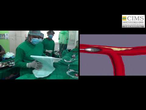 Step by step approach to Rotatripsy