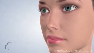 Rhinoplasty