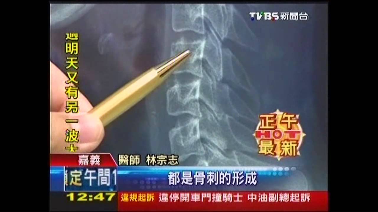 手指滑不停!26歲低頭族 頸椎長骨刺