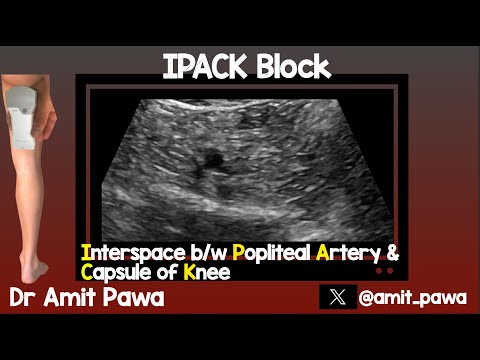 IPACK (Interspace between Popliteal Artery and Capsule of the Knee)