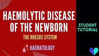 Haemolytic Disease of the Newborn (Rhesus System) - Medical Tutorial