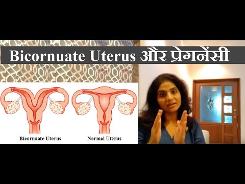 Bicornuate Uterus एक ठोस वजह गर्भ धारण न होने की - Bicornuate Uterus Treatment