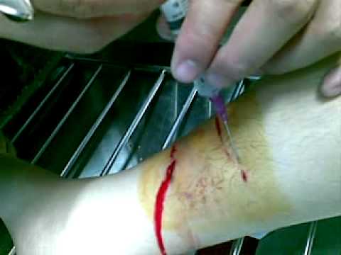 Neurodermatitis น้ำมันมะพร้าว โรคสะเก็ดเงินรูปภาพหลังหู
