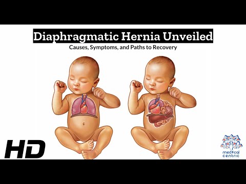 Hydrocephalus Causes Signs and Symptoms Diagnosis and Treatment