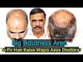 Best Hair Transplant Of 50 Years Old Patient Non Celebrity Hair Transplant