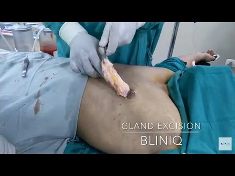 Patient Recovery Case — Video 21 (Gynecomastia)