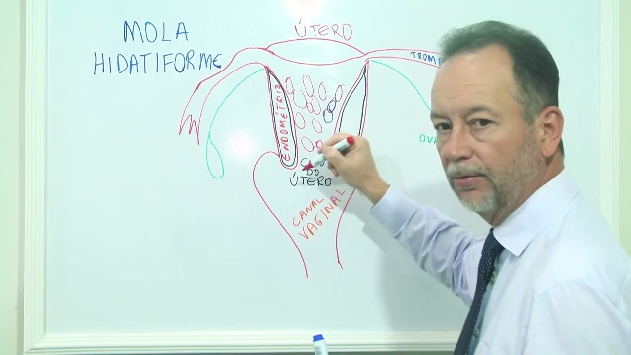 Gestação Molar - Mola Hodatiforme