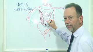Gestação Molar - Mola Hodatiforme