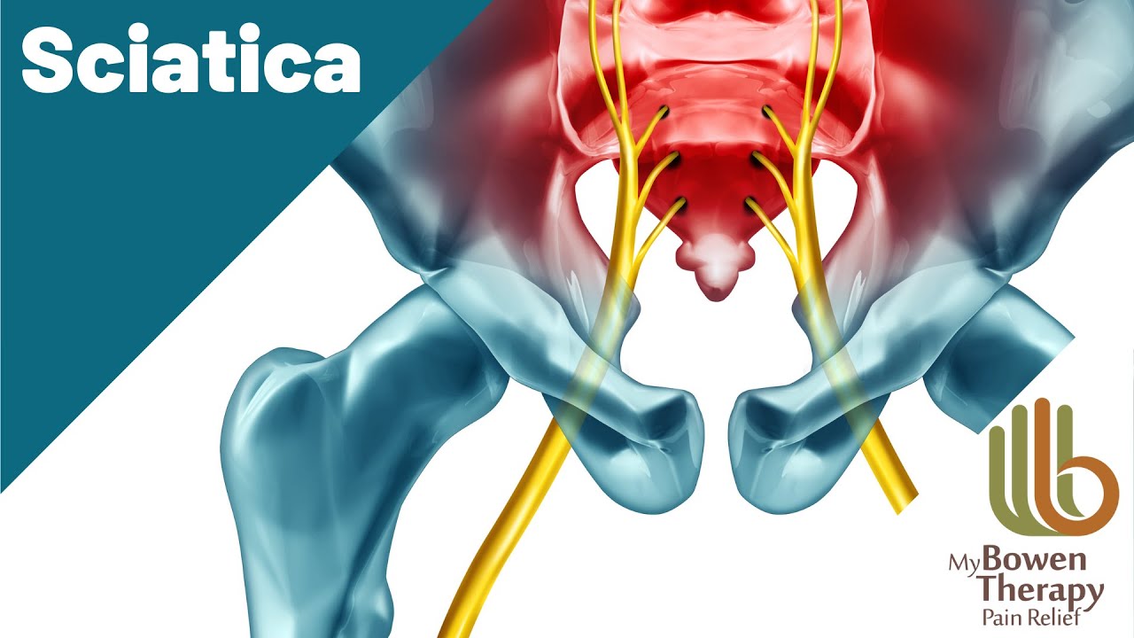 Sciatica -  A Bigger Picture?