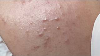 Blackhead & Whitehead Extractions #HoangMySpa198