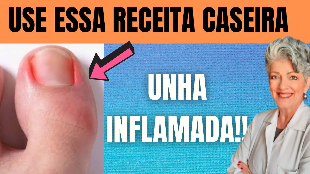 REMÉDIO CASEIRO Para UNHA INFLAMADA