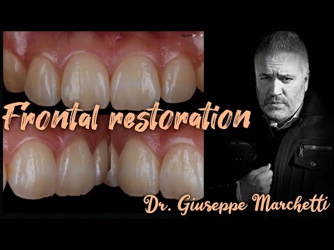 Frontal Composite Restoration Of Teeth