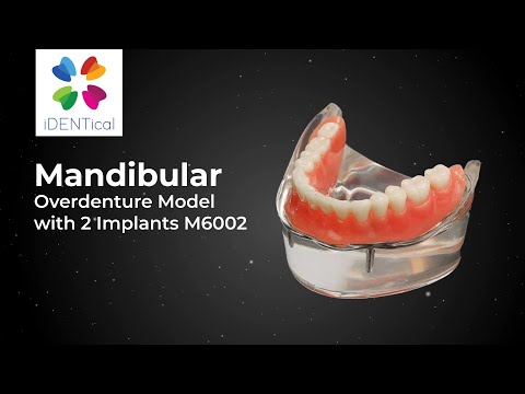 iDENTical Mandibular Overdenture Model with 2 Implants M6002