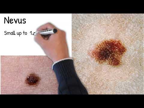 Nevus - Moles.  Which nevi are dangerous? Freckles and moles are  the same?