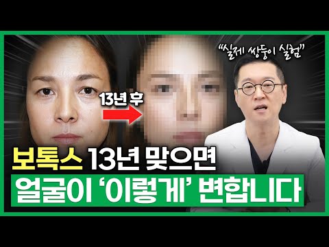 What 13 Years of Botox Does to Your Face