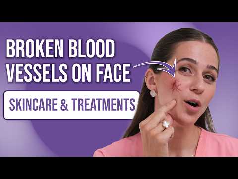 Fix Broken Blood Vessels On Face