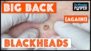The Third Return of Big Back Blackheads!  Dr Pimple Popper