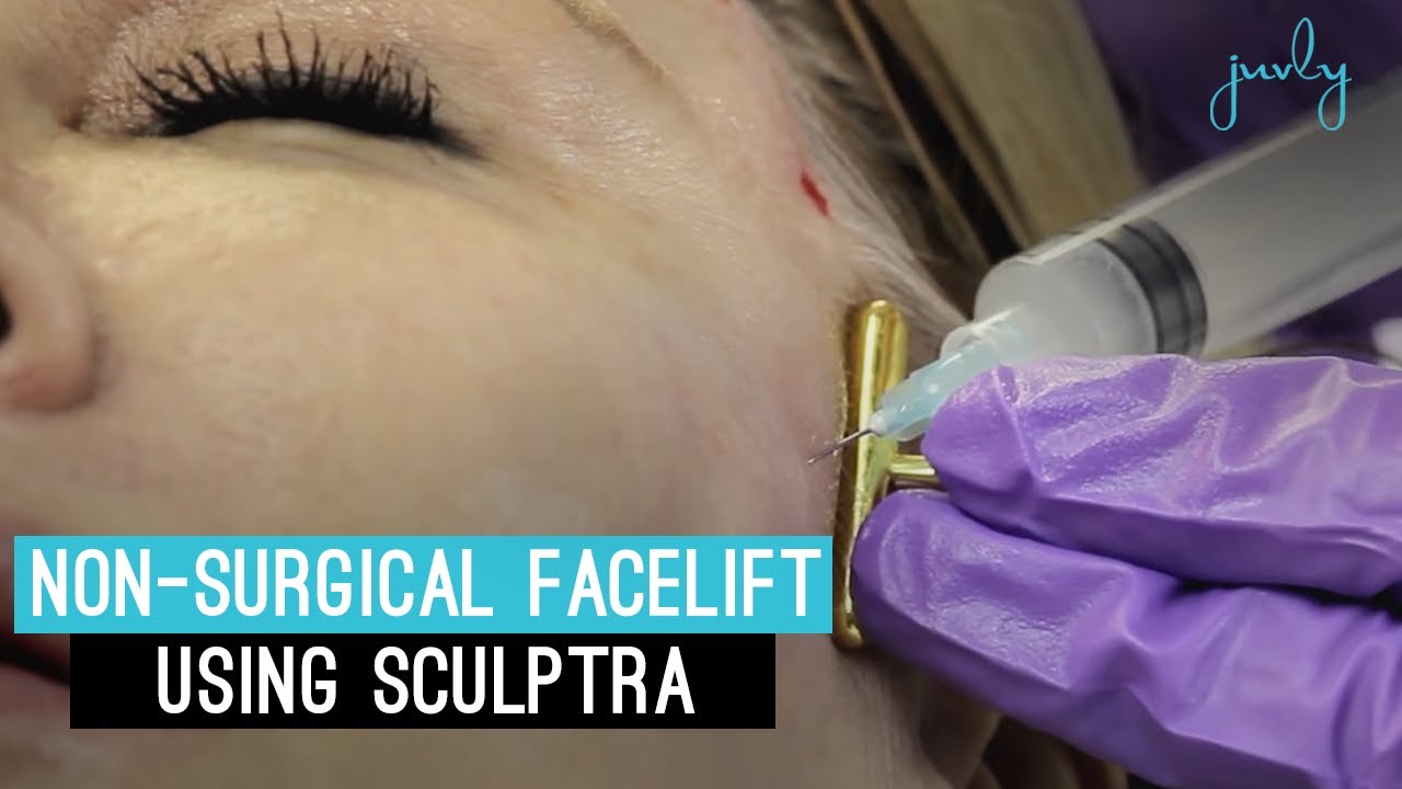 Non-Surgical Facelift Using Sculptra | Facial Volume Restoration Before and After images at Juvly