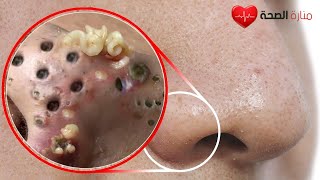 Remove blackheads from the nose permanently in minutes