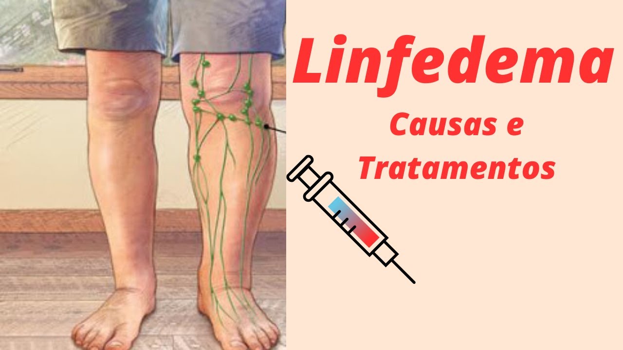 Linfedema: Causas e Tratamentos
