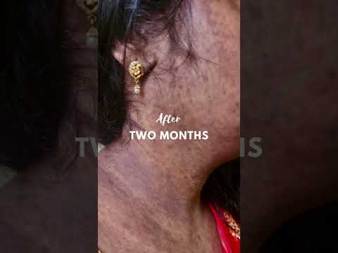 Lpp,Lichen planus pigmentosus # lpp #lppcure #lpptreament