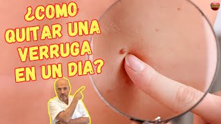 ✅ ¿COMO QUITAR UNA VERRUGA EN UN DIA? ✅