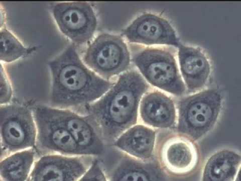 Radioterapia nel trattamento del cancro alla prostata Bacche di rosa canina con le pietre in prostata